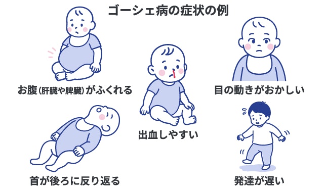 ゴーシェ病の赤ちゃんに見られる5つの症状をイラストで解説。肝臓や脾臓の腫大による「お腹がふくれる」、神経症状としての「目の動きがおかしい」、「首が後ろに反り返る（頸部後屈）」や、鼻血など「出血しやすい」、「発達が遅い」傾向がある。