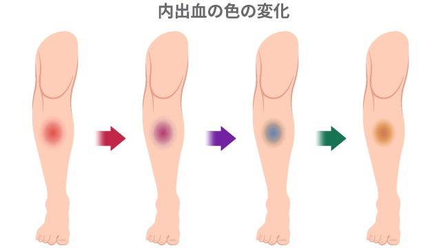 内出血の症状について説明する図です