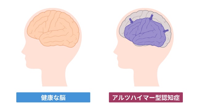 正常な脳とアルツハイマー型認知症の患者さんの脳のイラスト