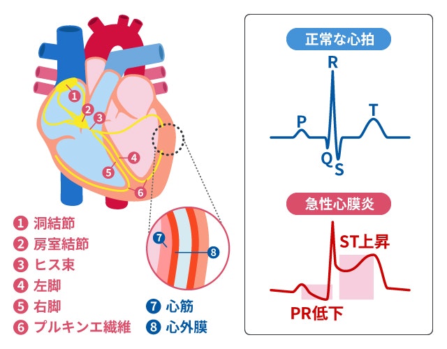 急性心膜炎が心電図でわかるかどうか説明している図です