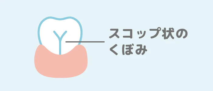 前歯の裏