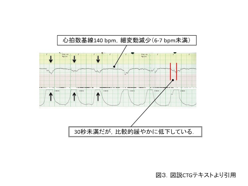 【新人助産師と学生が押さえておきたい】CTG（NST）モニターの基礎知識｜基線・基線細変動・一過性頻脈の見方をわかりやすく解説