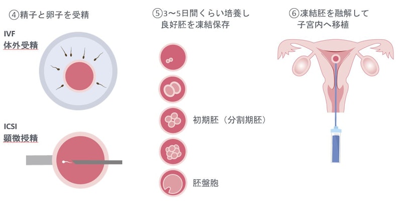 助産師が知っておくべき不妊治療の基礎知識|タイミング法から体外受精まで基本をおさらい