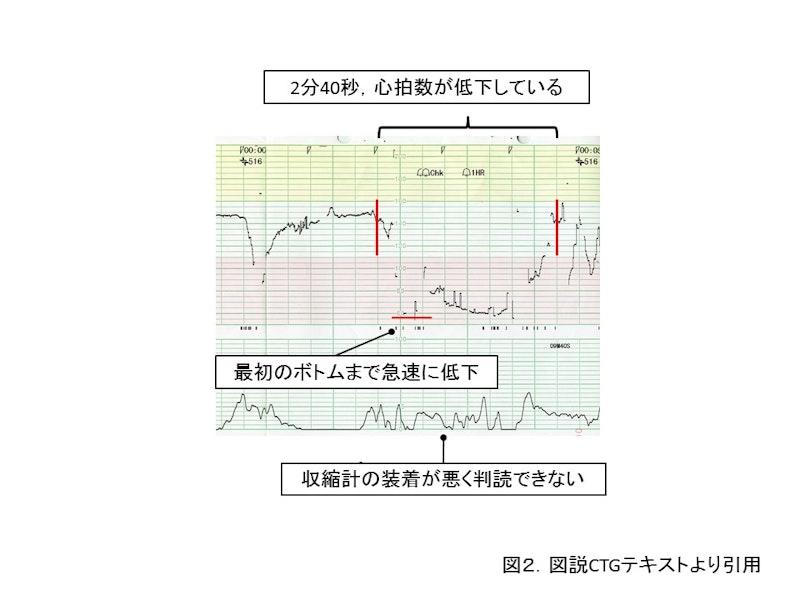 【新人助産師と学生が押さえておきたい】CTG（NST）モニターの基礎知識｜基線・基線細変動・一過性頻脈の見方をわかりやすく解説