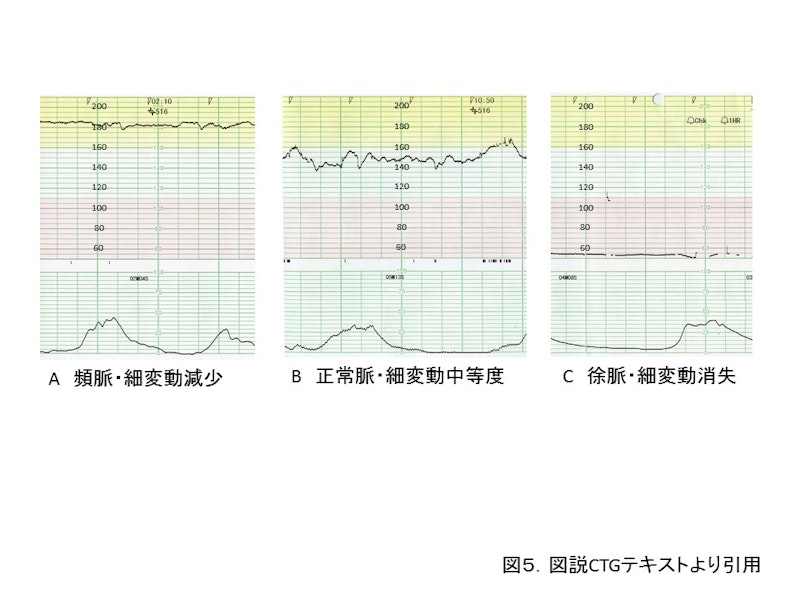 【新人助産師と学生が押さえておきたい】CTG（NST）モニターの基礎知識｜基線・基線細変動・一過性頻脈の見方をわかりやすく解説