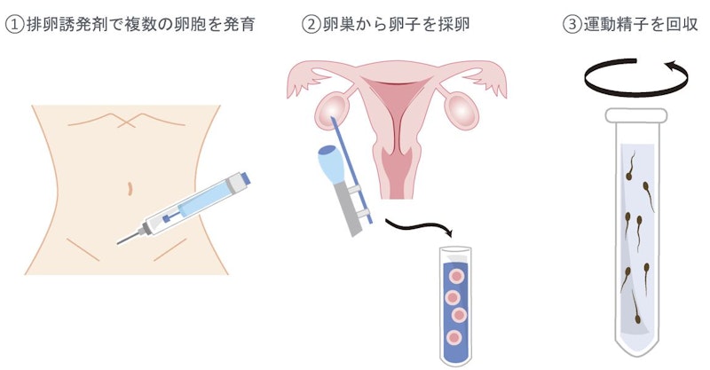 助産師が知っておくべき不妊治療の基礎知識|タイミング法から体外受精まで基本をおさらい