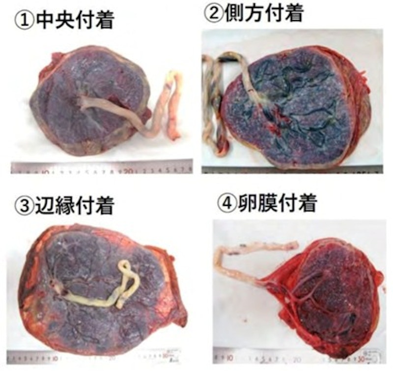 胎盤のどこを見る?新人助産師が知っておくべき観察項目と異常所見