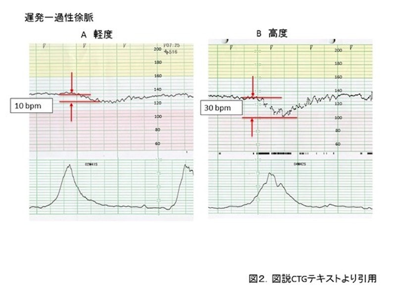 助産師が押さえておきたいCTGモニターの判読|一過性徐脈の判別ポイントと対応まとめ