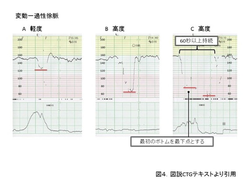 助産師が押さえておきたいCTGモニターの判読|一過性徐脈の判別ポイントと対応まとめ