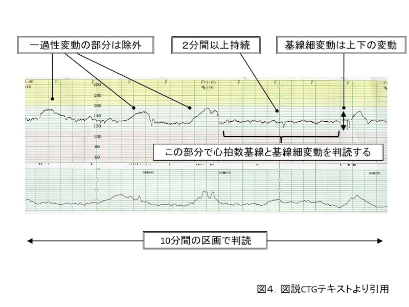 【新人助産師と学生が押さえておきたい】CTG（NST）モニターの基礎知識｜基線・基線細変動・一過性頻脈の見方をわかりやすく解説