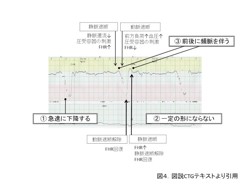 【新人助産師と学生が押さえておきたい】CTG（NST）モニターの基礎知識｜基線・基線細変動・一過性頻脈の見方をわかりやすく解説