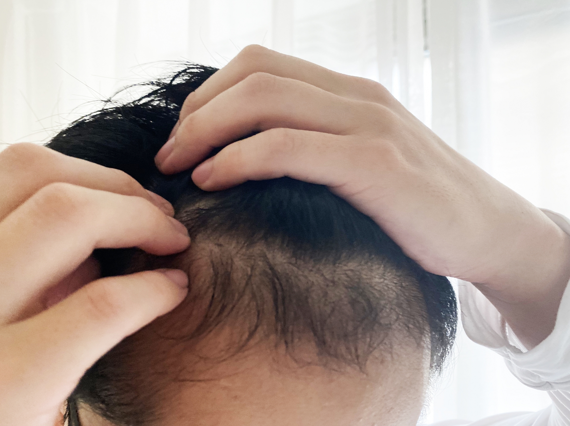 薄毛に悩む男性必見！AGA治療の最新植毛法と効果