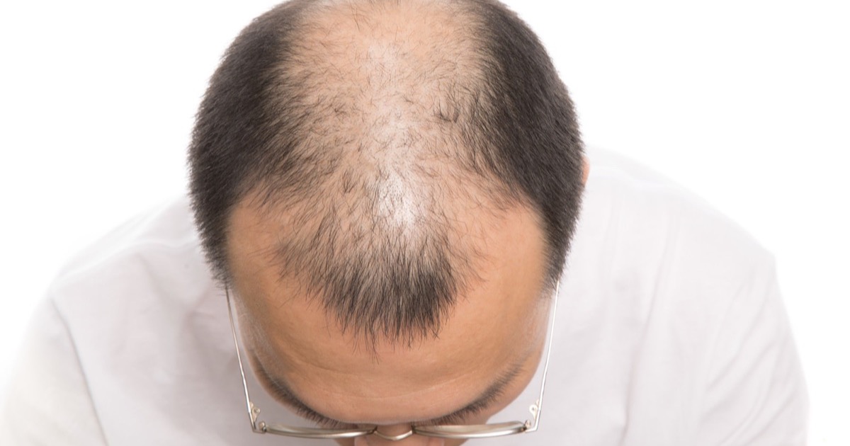 薄毛に悩む男性必見!AGA治療の最新植毛法と効果