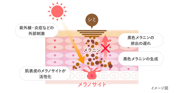 シミの色と深さ