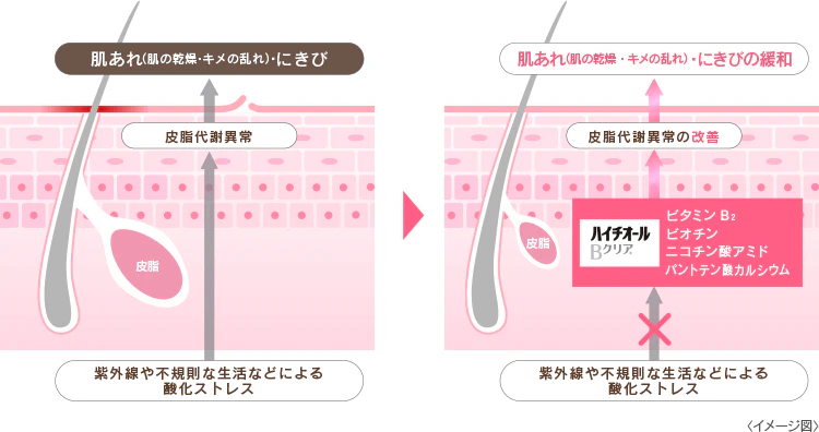 皮脂の代謝異常と改善
