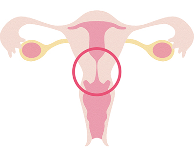 子宮の出口がせまい
