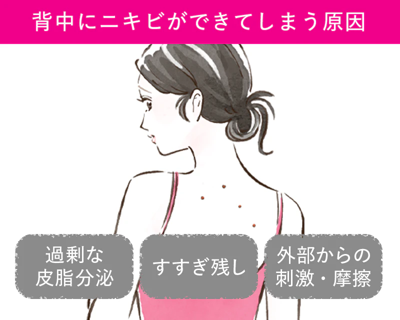 背中ニキビの原因