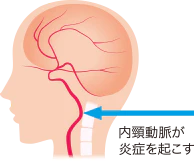 群発頭痛の原因とメカニズムの図説