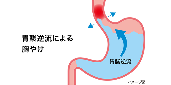 胃酸逆流による胸やけ