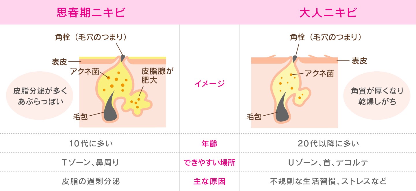 ニキビ の 原因