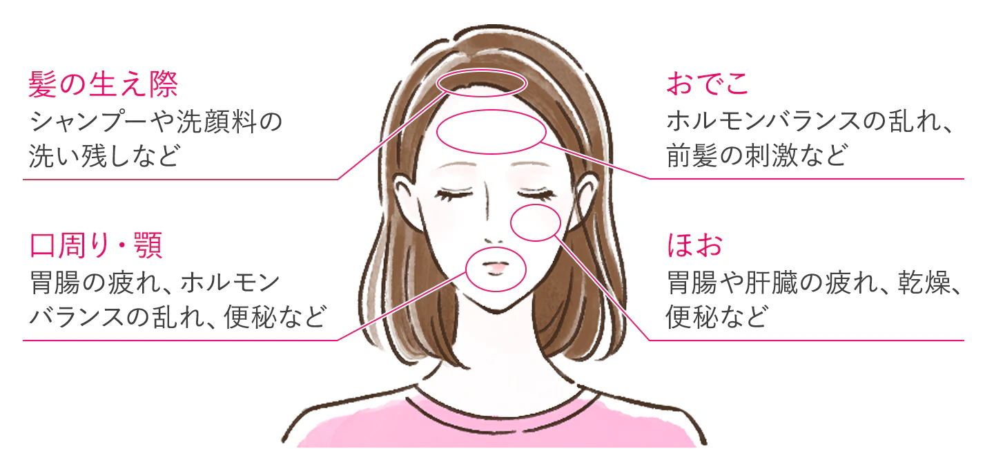 肌荒れのできやすい場所と原因のイラスト