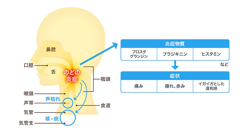 のどの炎症がのどの痛みを引き起こすイメージ図