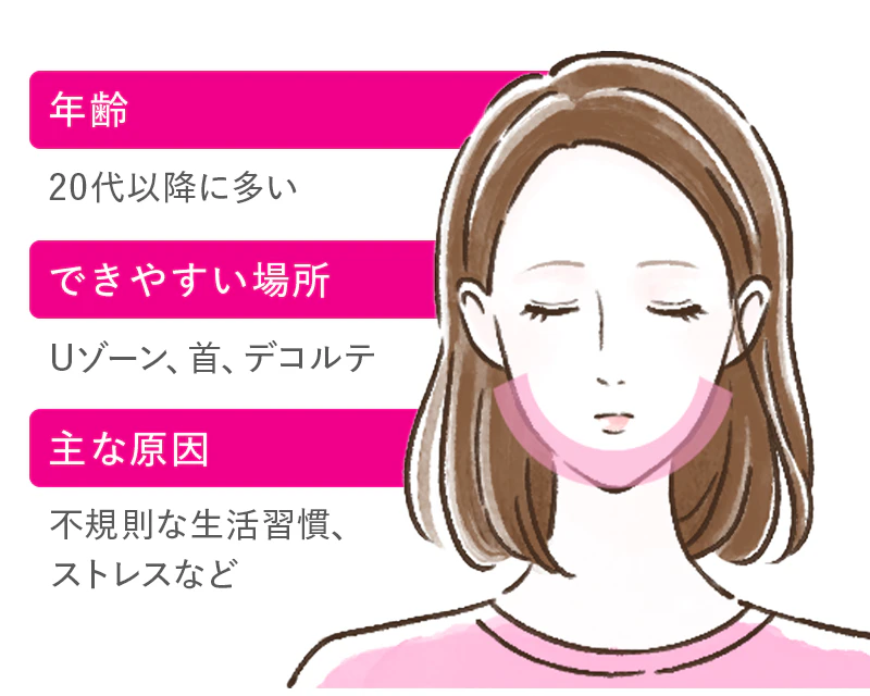 あごニキビの原因