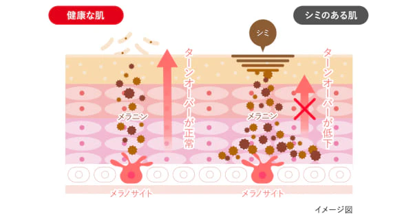 シミの色と深さ