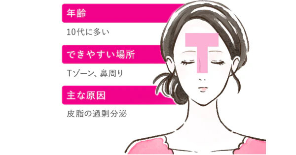 Tゾーン、鼻周り