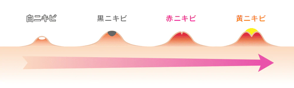 ニキビの進行