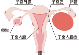 子宮筋腫