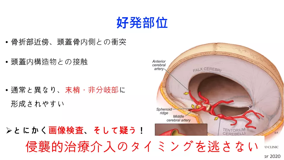 未破裂脳動脈瘤-基本のキ- | Dr.'s Prime Academia（ドクターズ