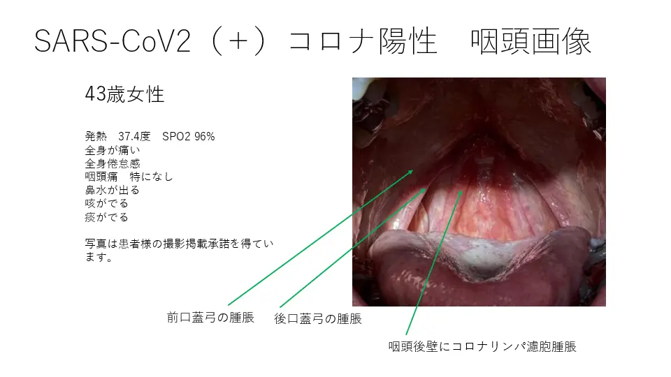 COVID-19罹患者120症例から咽頭所見の考察 | Dr.'s Prime Academia