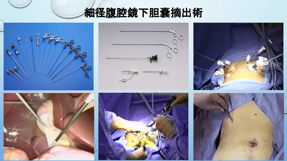 腹腔鏡下胆嚢摘出術を極めるためには何が必要か？ー実践編①ー | Dr.'s