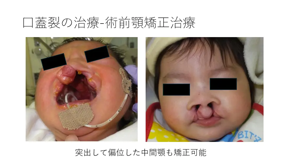 形成外科医が伝える！ 口唇口蓋裂の診断と治療 〜非専門医が知っておく