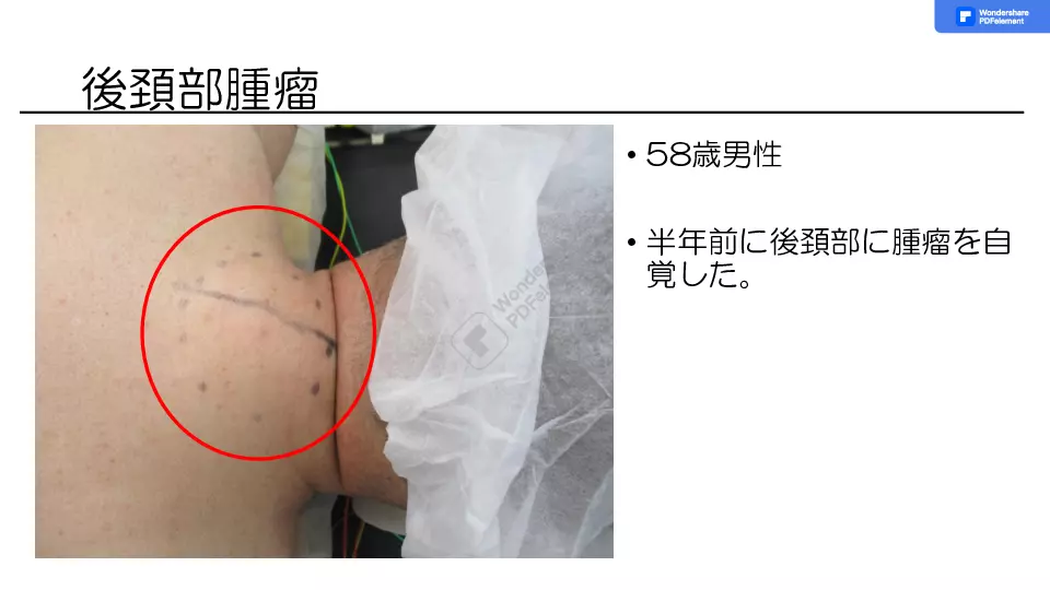 しこりをみたら〜しこり治療の基礎から応用まで〜 | Dr.'s Prime