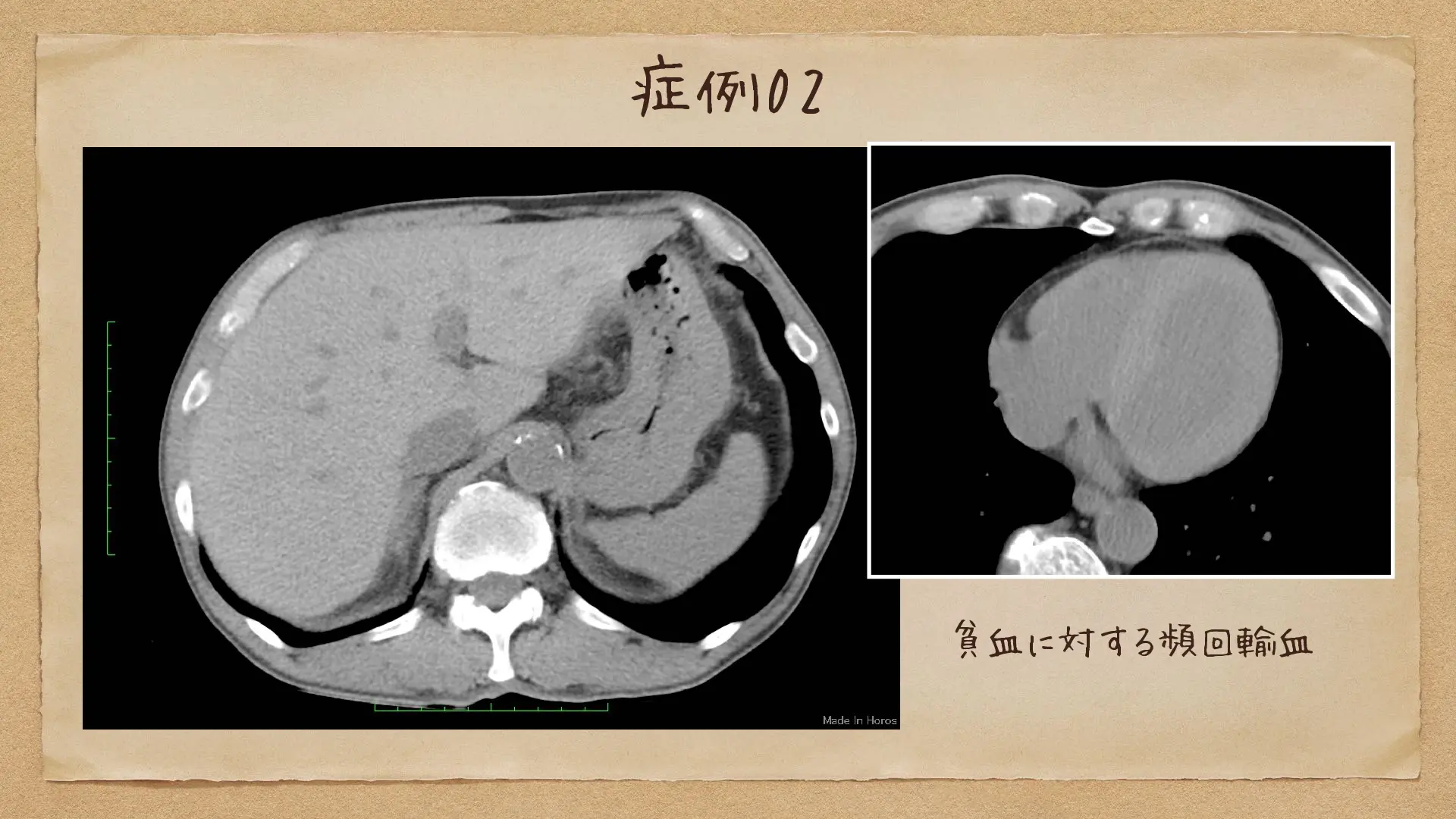 救急画像診断ことはじめ 〜腸管の見方ことはじめ その1〜 | Dr.'s