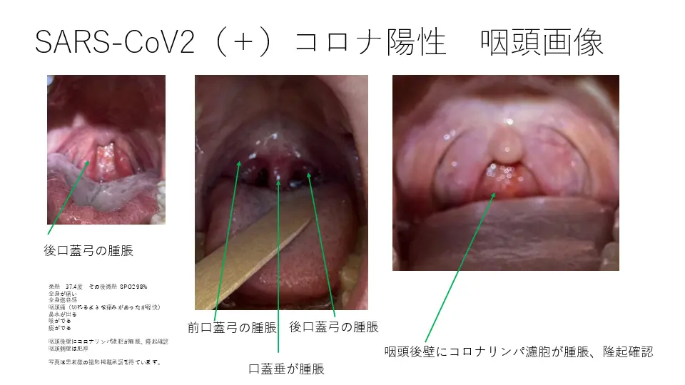 COVID-19罹患者120症例から咽頭所見の考察 | Dr.'s Prime Academia