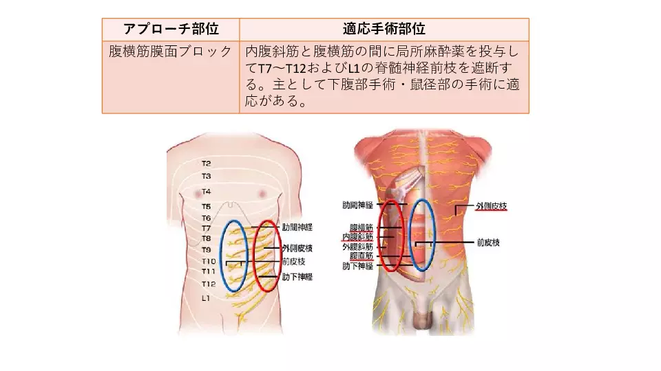麻酔と術後鎮痛基本のキ・・・これで安心術後疼痛管理 | Dr.'s Prime