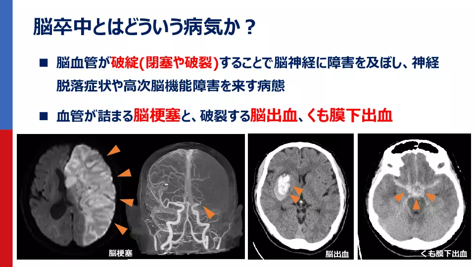 非専門医でもわかる！脳卒中初期診療の基本 | Dr.'s Prime Academia