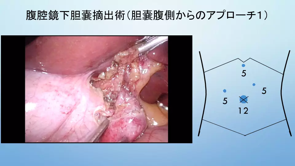 腹腔鏡下胆嚢摘出術を極めるためには何が必要か？ー実践編①ー | Dr.'s