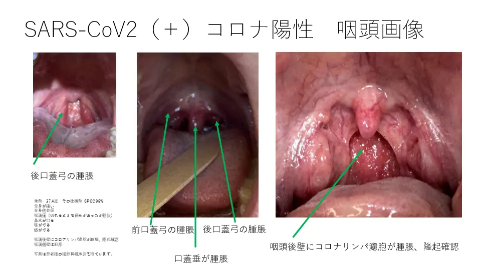 COVID-19罹患者120症例から咽頭所見の考察 | Dr.'s Prime Academia
