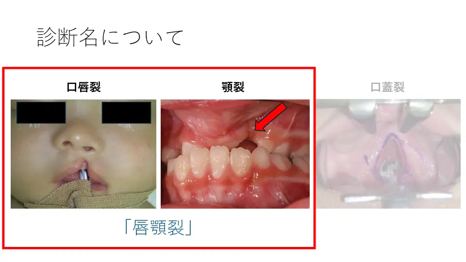 形成外科医が伝える！ 口唇口蓋裂の診断と治療 〜非専門医が知っておく