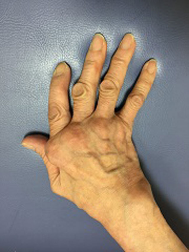 リウマチによる手の変形