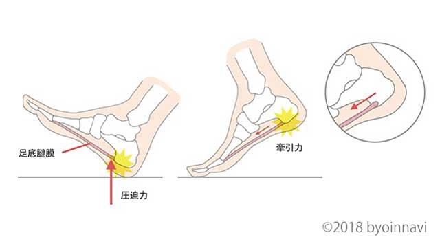 足底腱膜炎が発症するメカニズム