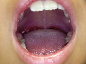 手足口病の口腔内の発疹画像