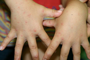 手足口病の手の発疹画像