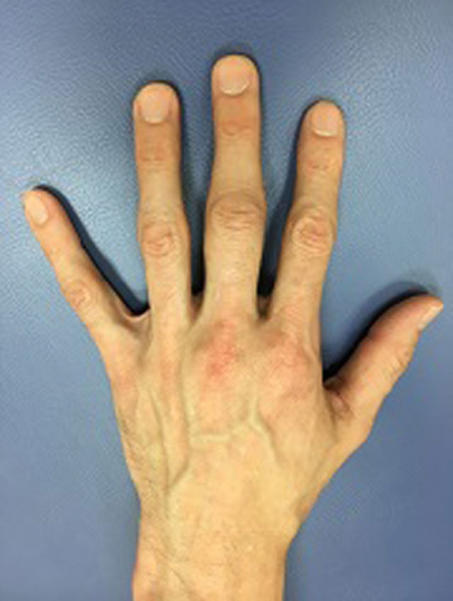 関節リウマチ初期の患者さんの手