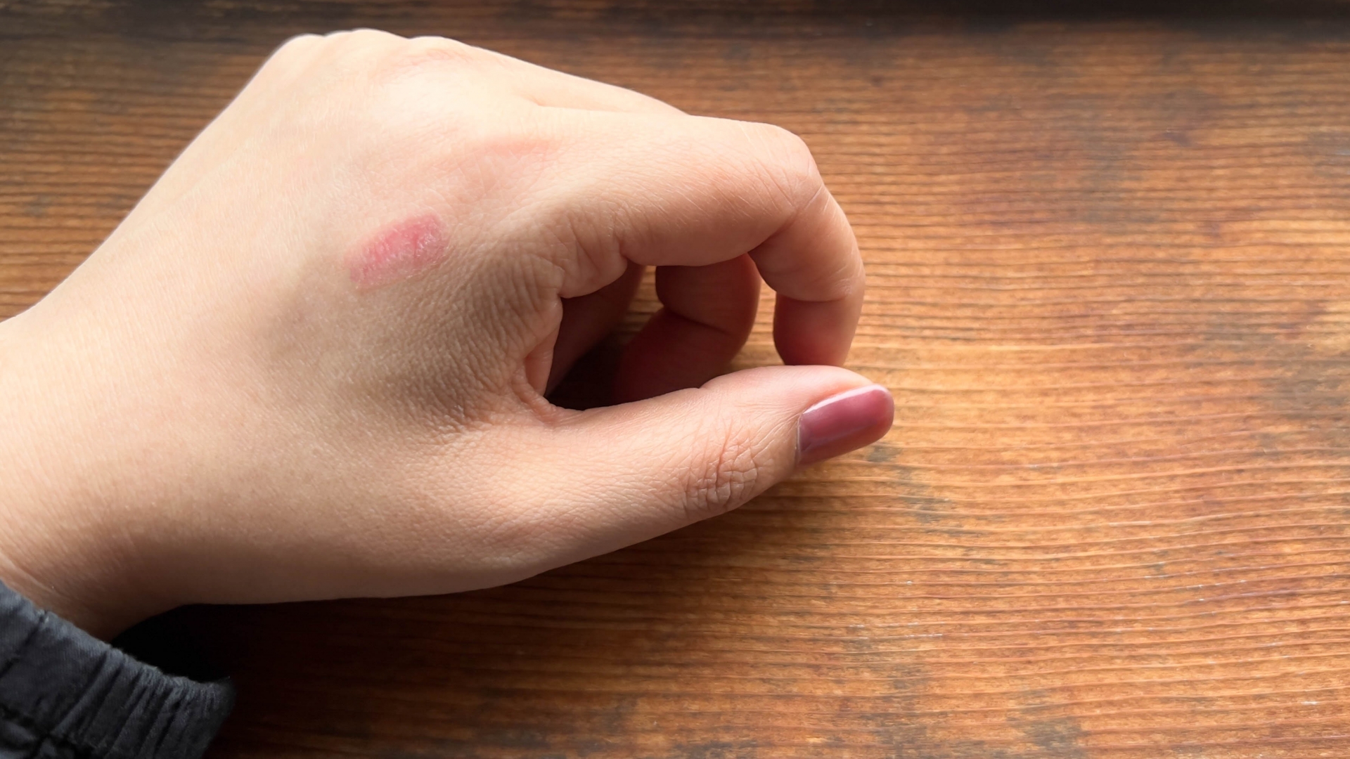 「痛くないから大丈夫」は絶対NG！低温やけどの初期症状