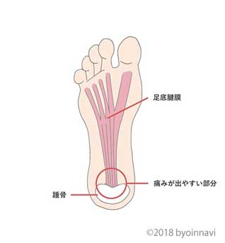 足底腱膜炎で痛みが出やすい部分